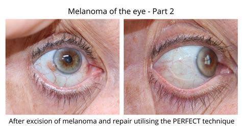 Pterygium Removal