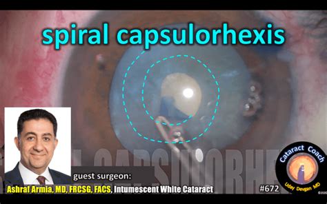 Spiral Capsulorhexis Technique – Cataract Coach™