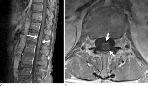 The Usefulness of Lumbar Spine MRI for Cauda Equina Syndrome