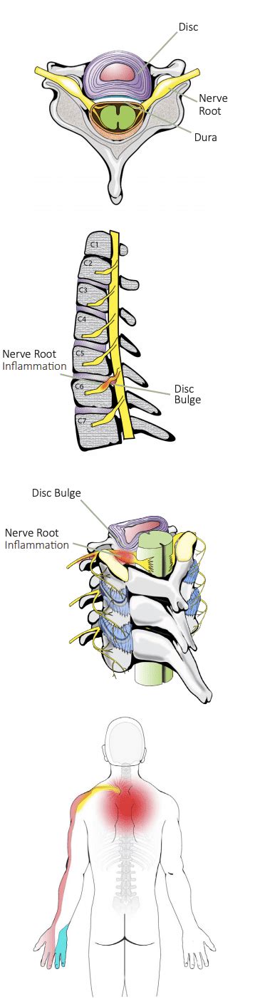 Cervical Transforaminal Steroid Injection - Highland, IN: Kanuru Interventional Spine and Pain ...