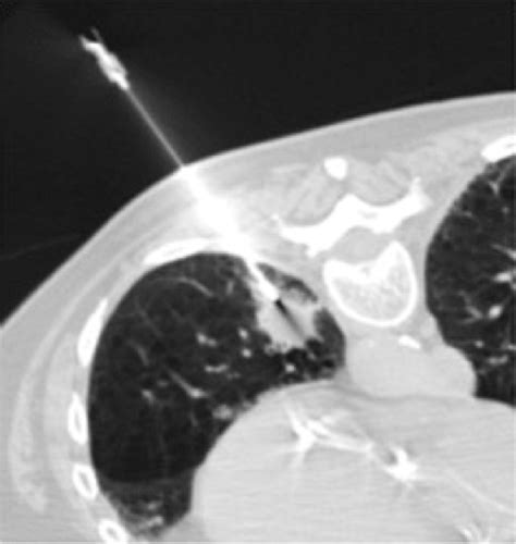 CT-guided Lung Biopsy: Effect of Biopsy-side Down Position on ...