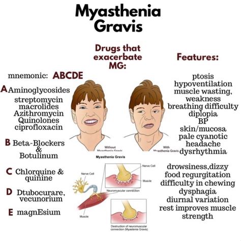 Myasthenia Gravis - MEDizzy