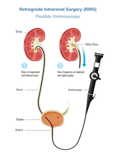 RIRS Surgery in Dehradun - Best Hospital for RIRS