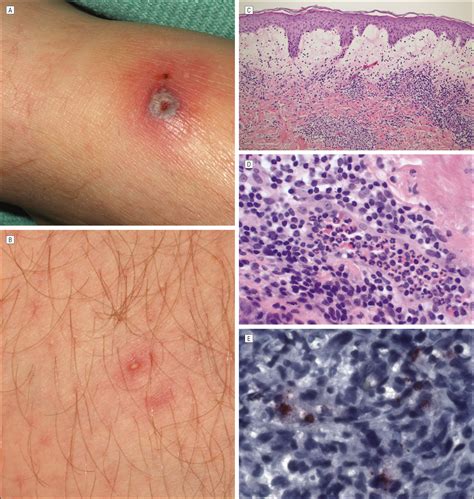 The Expanding Spectrum of Eschar-Associated Rickettsioses in the United States | Infectious ...