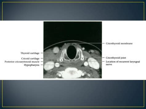 Larynx anatomy ct and mri