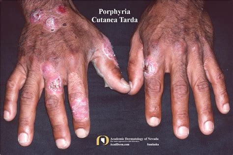 Porphyria Cutanea Tarda (PCT): A Photosensitive Disorder... - Academic ...