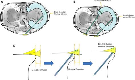 Meniscus Root Tear - Sun Orthopaedic