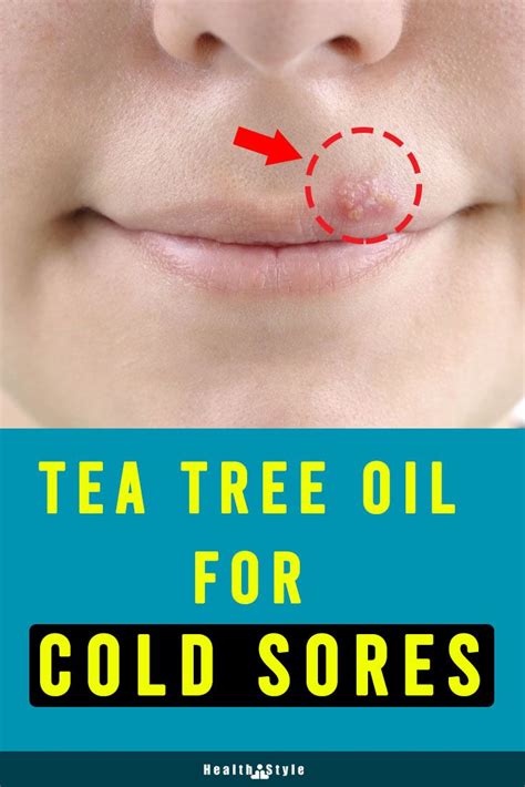 Get Rid of Cold Sores with Tea Tree Oil in 2020 | Cold sore, Tea tree ...