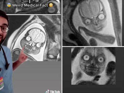 baby mri scan results - Nelly Harter