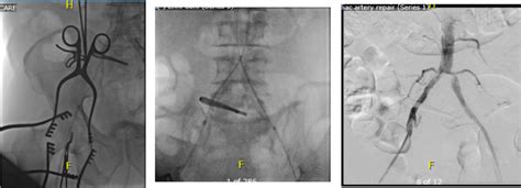 Femoral Endarterectomy Procedure