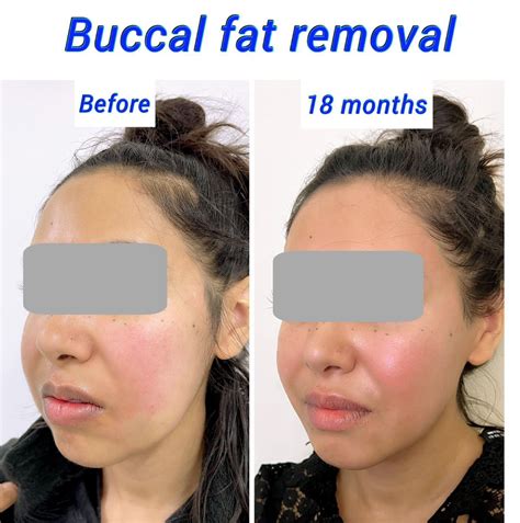 Buccal Fat Pad Removal - Harley Clinic