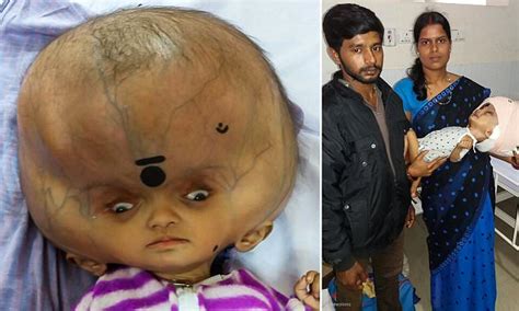 Boy with world's largest head has surgery to remove fluid from around his skull | Daily Mail Online