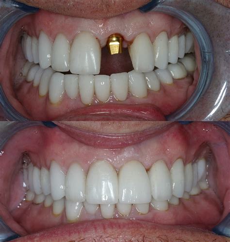 Before & After Implant Retained Crowns - Cosmetic Dentists of Houston ...