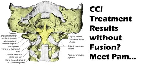 Craniocervical Instability Treatment ~ Pam's Story