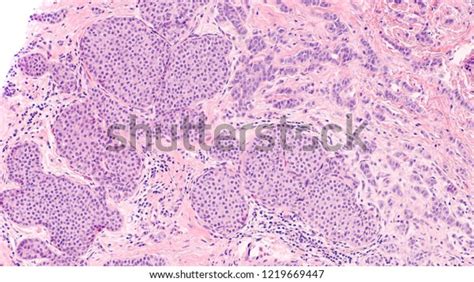 Breast Cancer Histology Lobular Carcinoma Situ Stock Photo (Edit Now ...