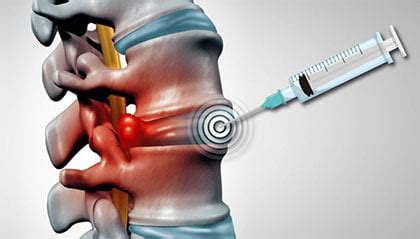 Cervical Epidural Steroid Injection NYC | Injections for Back Pain New York