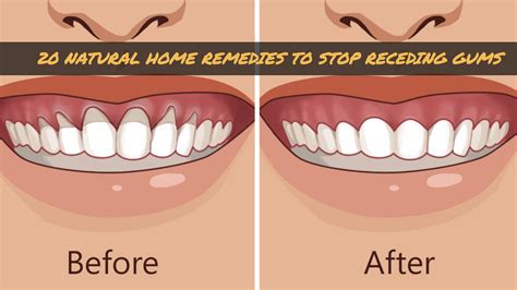 20 Natural Home Remedies To Stop Receding Gums – Wellness.guide