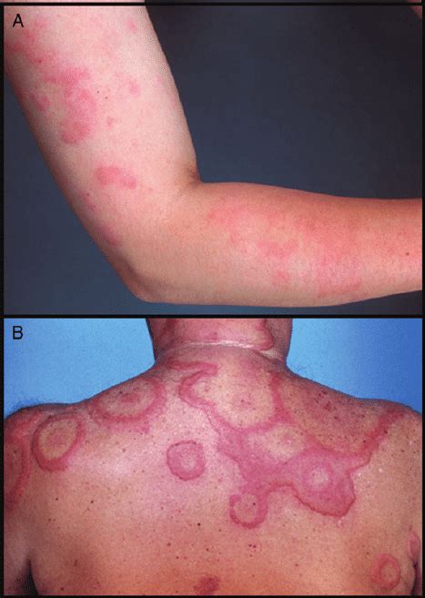 Examples of urticarial skin lesions resulting from drug... | Download ...