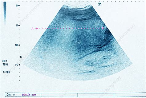 Hepatomegaly, pelvic ultrasound - Stock Image - C027/2736 - Science Photo Library