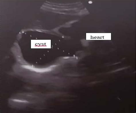 Intact right lung hydatid cyst attached to the heart measuring 11 x 7cm. | Download Scientific ...