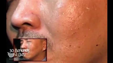 Removing sinus worm parasites from mans face aka "the resdung scam" - YouTube