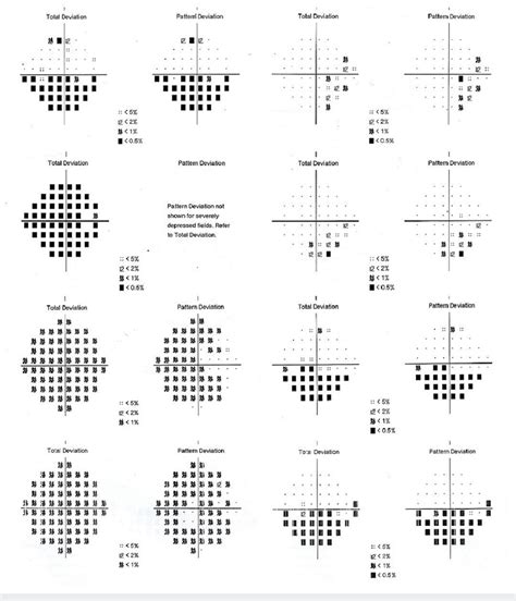 HVF shows right eye progressed from inferior altitudinal scotoma to ...