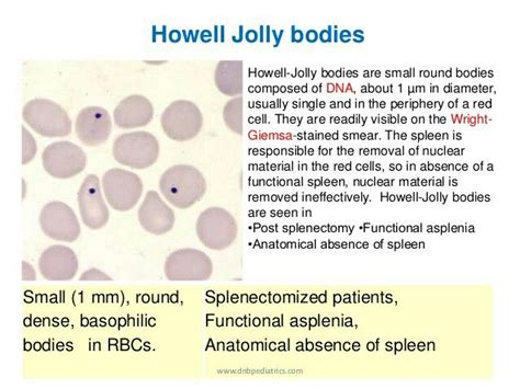 Howell Jolly bodies ( Nuclear remnants in RBC ) - Splenic dysfunction ...