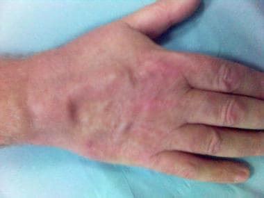 Wrist Arthritis Clinical Presentation: History, Physical Examination