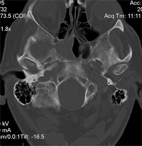 CT image of mass in sphenoid sinus transverse | Download Scientific Diagram