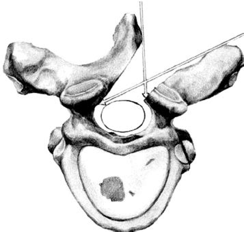 Schematic view after unilateral hemilaminectomy for exposure of the ...