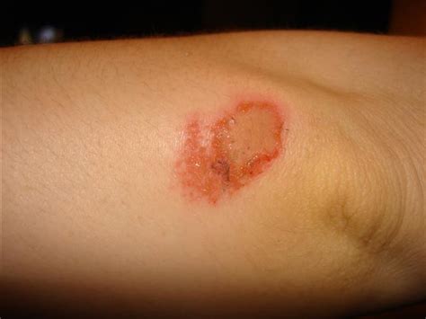 My elbow - and THE carpet burn injury. *looks at Grant* | Flickr ...