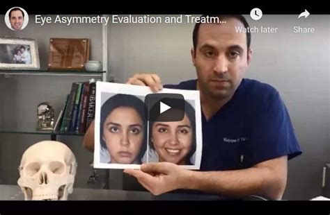 Eye Asymmetry Surgery and Treatment | Fix Uneven Eyes