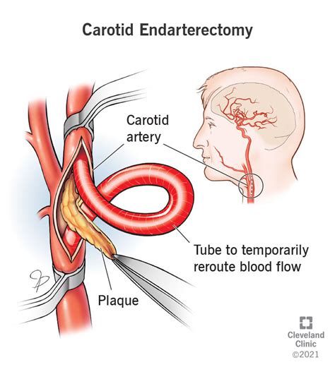 Carotid Endarterectomy: Treating Carotid Artery Disease | PressNewsAgency