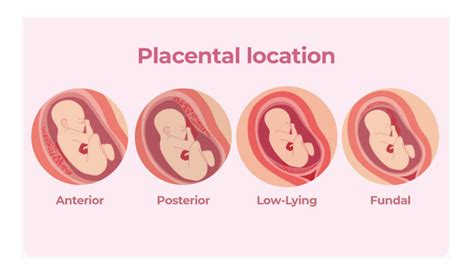 What Is a Circumvallate Placenta?