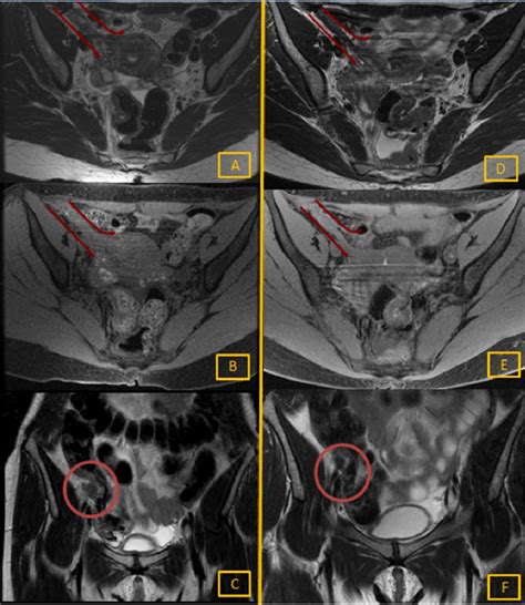 Endometriosis Imaging Mri at Lisa Bean blog