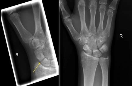 Scaphoid fracture - Radiology at St. Vincent's University Hospital