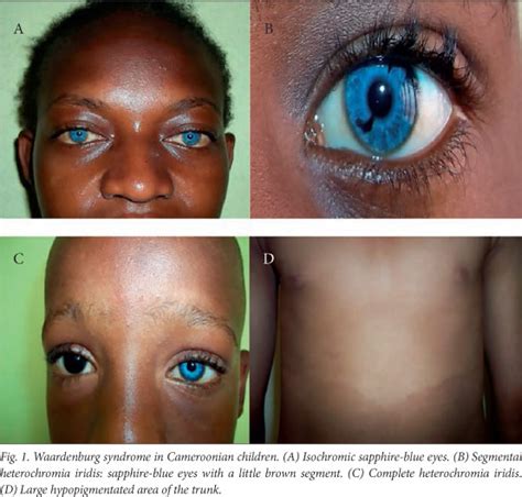 Waardenburg syndrome; Klein-Waardenburg Syndrome; Waardenburg's Syndrome