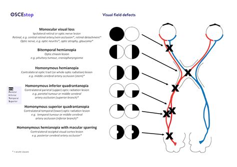 How Visual Fields Are Affected By Lesions Of Visual P - vrogue.co