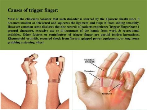 What is trigger finger & what are its symptoms!