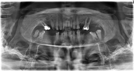 Preoperative panoramic view. Figure-3: With Michigan splint in position ...