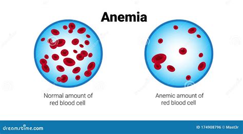 Of Normal and Anemia Amount of Red Blood Cells Medical Board Iron ...