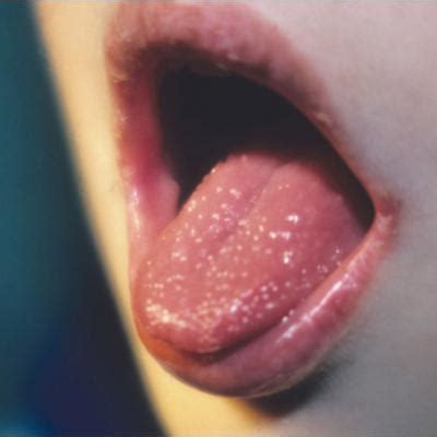 Papillae on tongue | MDedge Family Medicine