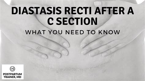 Diastasis Recti After A C-Section: [What You Need To Know] - Postpartum Trainer, MD