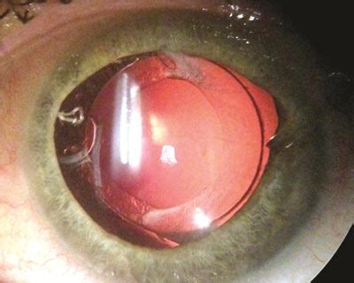 Cataract Pictures and Videos: What Do Cataracts Look Like? - Dr Lynette Venter | Ophthalmologist ...