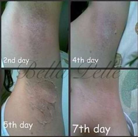 Top 101+ Images Laser Hair Removal Underarm Before And After Excellent