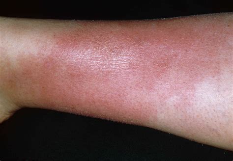 How Cellulitis Can Be Treated