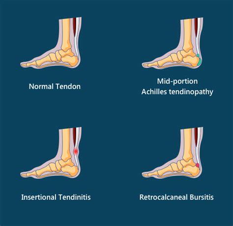 Insertional Tendinitis Massage Treatment in the Achilles Tendon