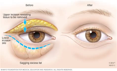 Bags under eyes Disease Reference Guide - Drugs.com