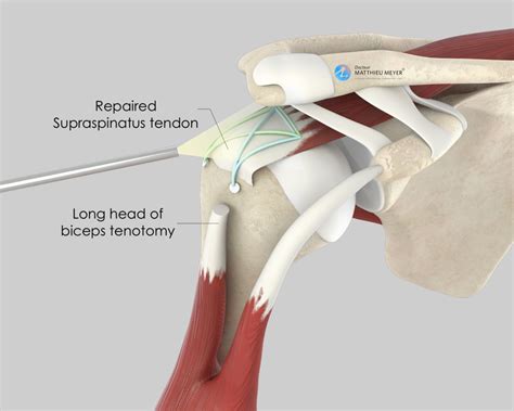 shame funnel Conform types of rotator cuff surgery sort generally Honest