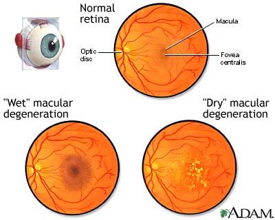 Macular degeneration: MedlinePlus Medical Encyclopedia Image